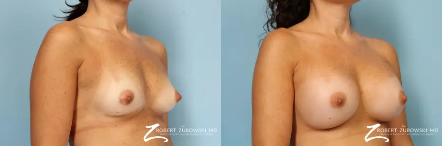 Breast Augmentation: Patient 40 - Before and After 2