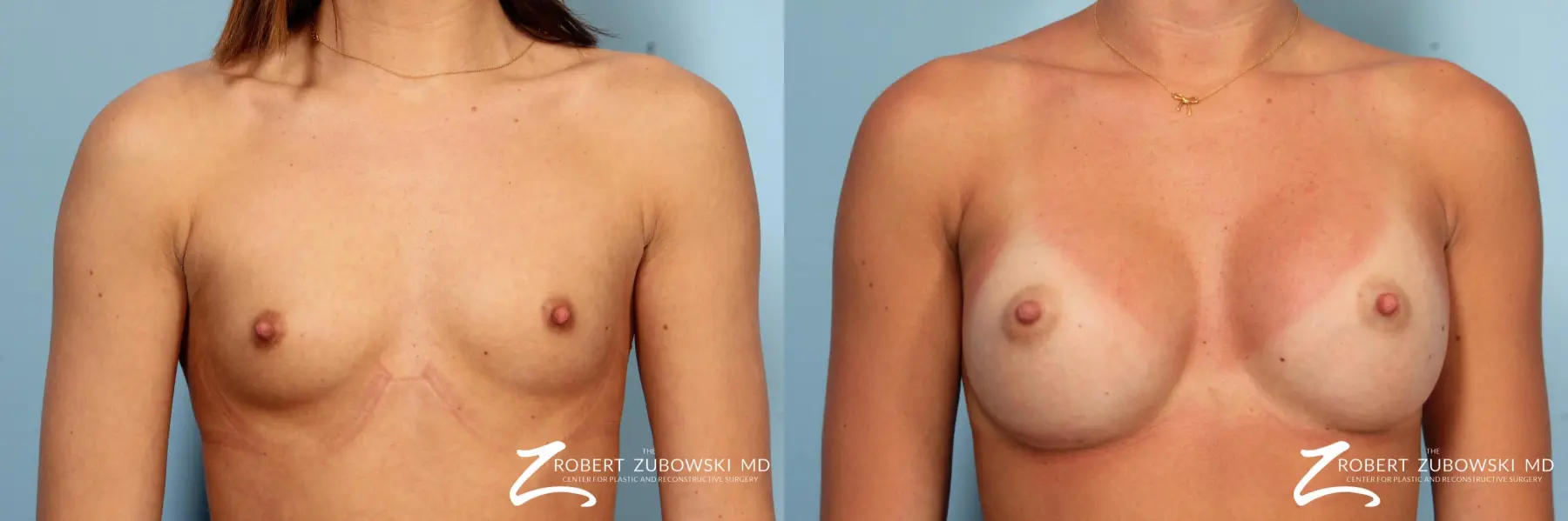 Breast Augmentation: Patient 37 - Before and After  