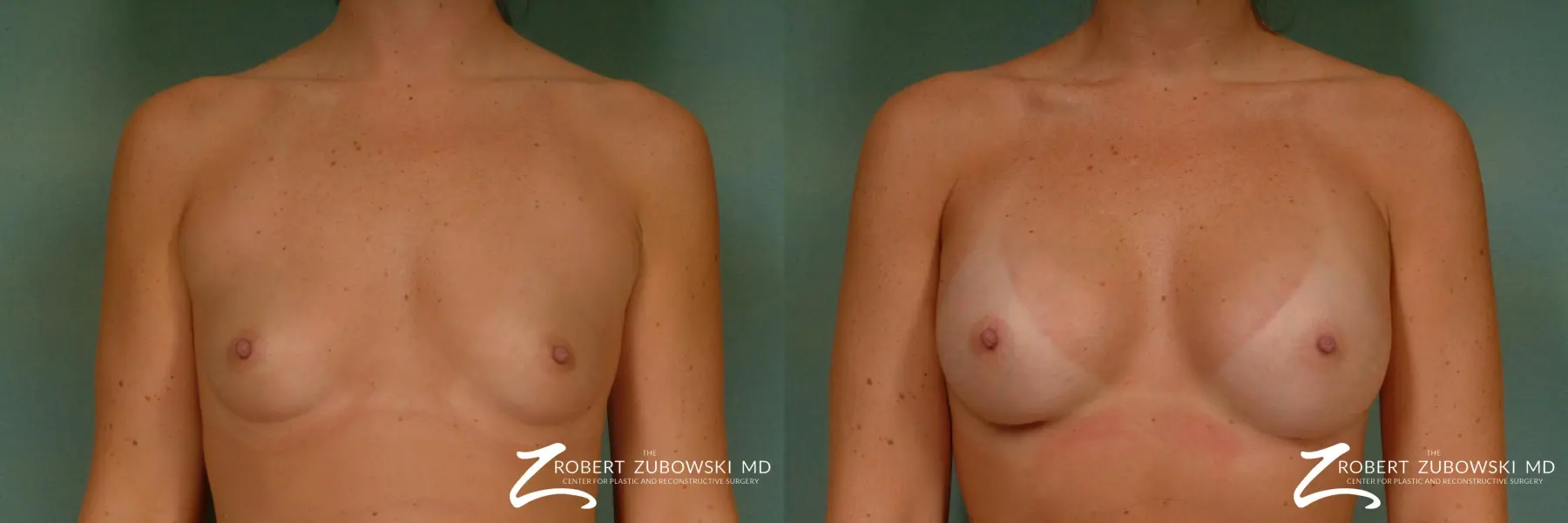 Breast Augmentation: Patient 4 - Before and After  