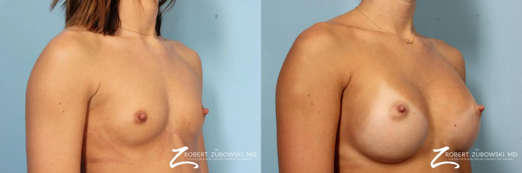 Breast Augmentation: Patient 37 - Before and After 2