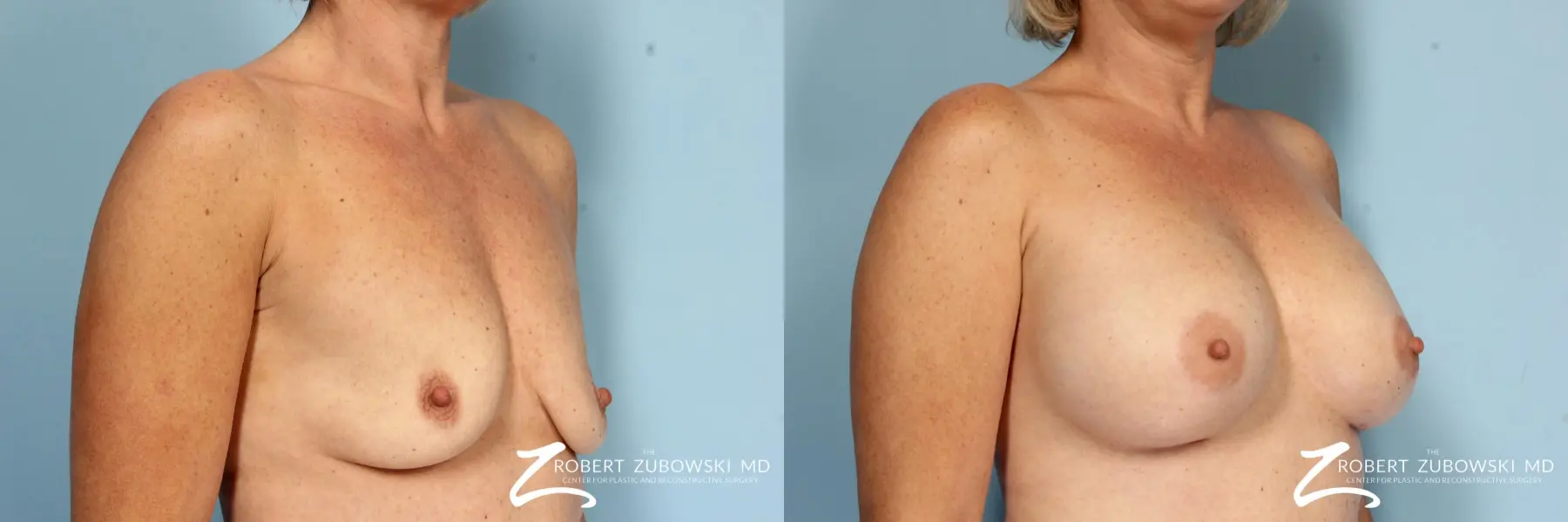 Breast Augmentation: Patient 38 - Before and After 3