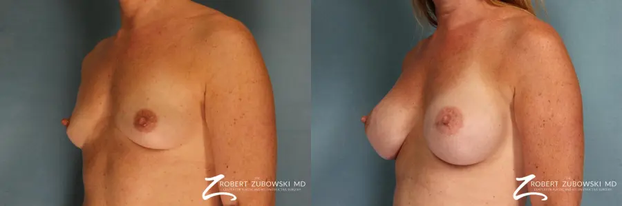 Breast Augmentation: Patient 3 - Before and After 2