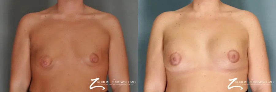 Breast Lift And Augmentation: Patient 11 - Before and After 1