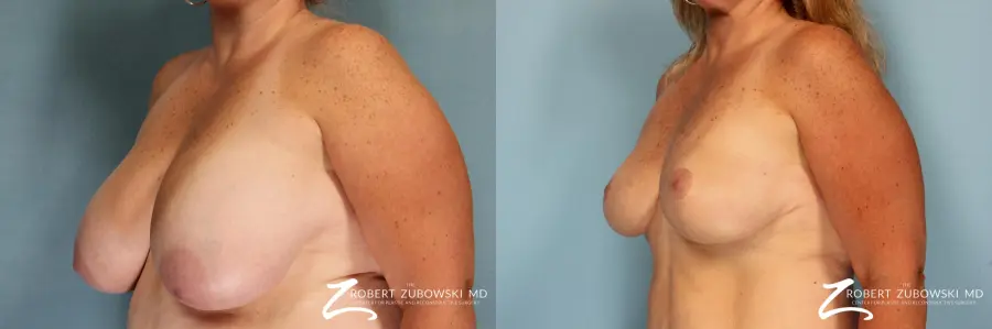 Breast Lift And Augmentation: Patient 11 - Before and After 2