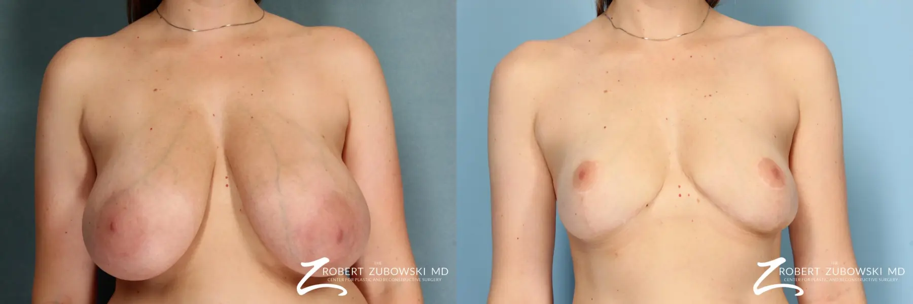 Breast Lift And Augmentation: Patient 10 - Before and After  