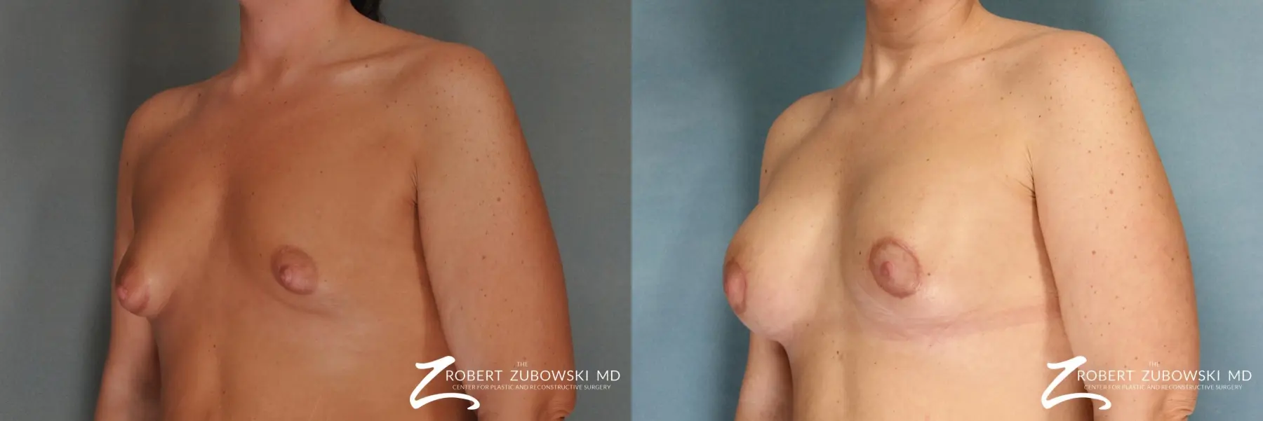 Breast Lift And Augmentation: Patient 12 - Before and After 2