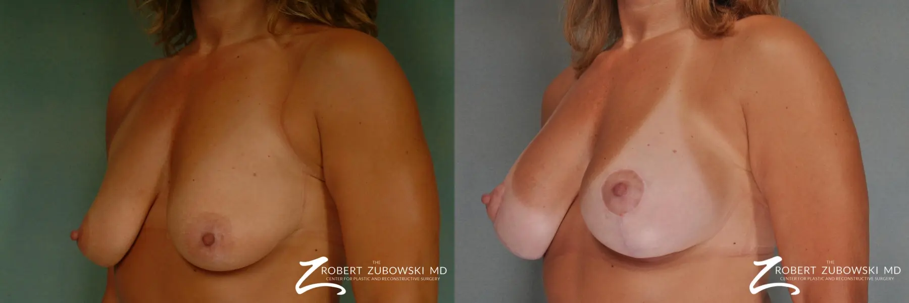 Breast Lift And Augmentation: Patient 5 - Before and After 2