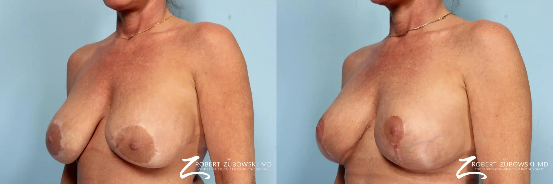Breast Lift And Augmentation: Patient 17 - Before and After 2
