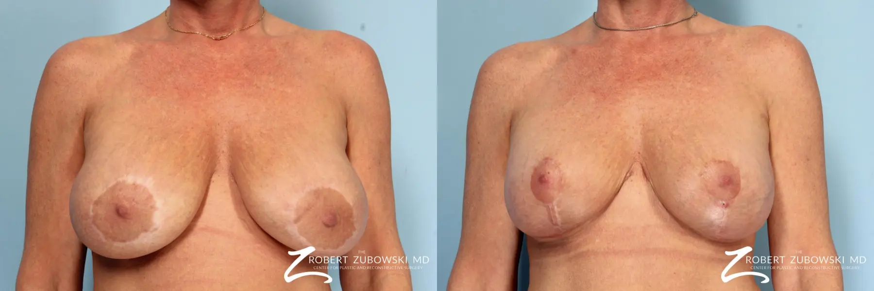 Breast Lift And Augmentation: Patient 17 - Before and After 1