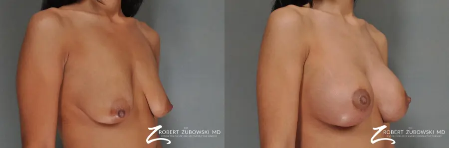 Breast Lift And Augmentation: Patient 7 - Before and After 2