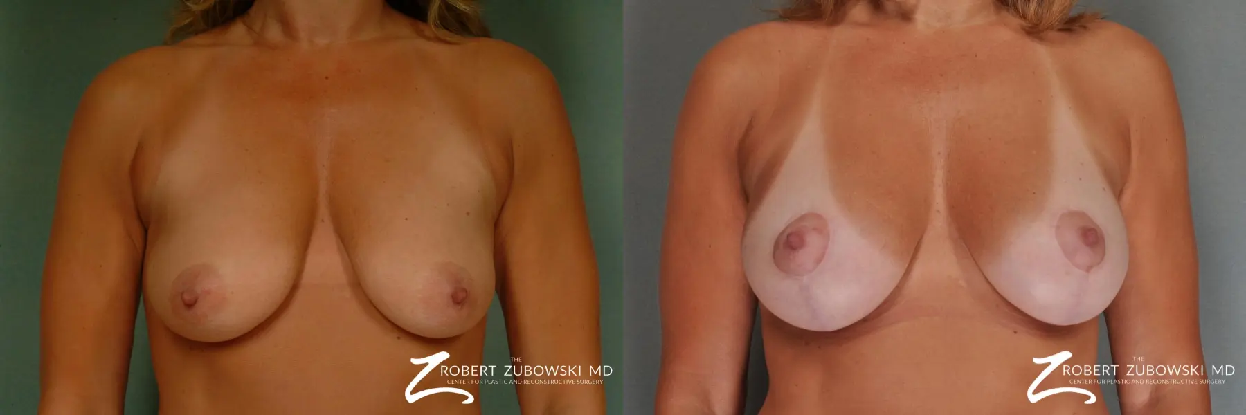 Breast Lift And Augmentation: Patient 5 - Before and After 1