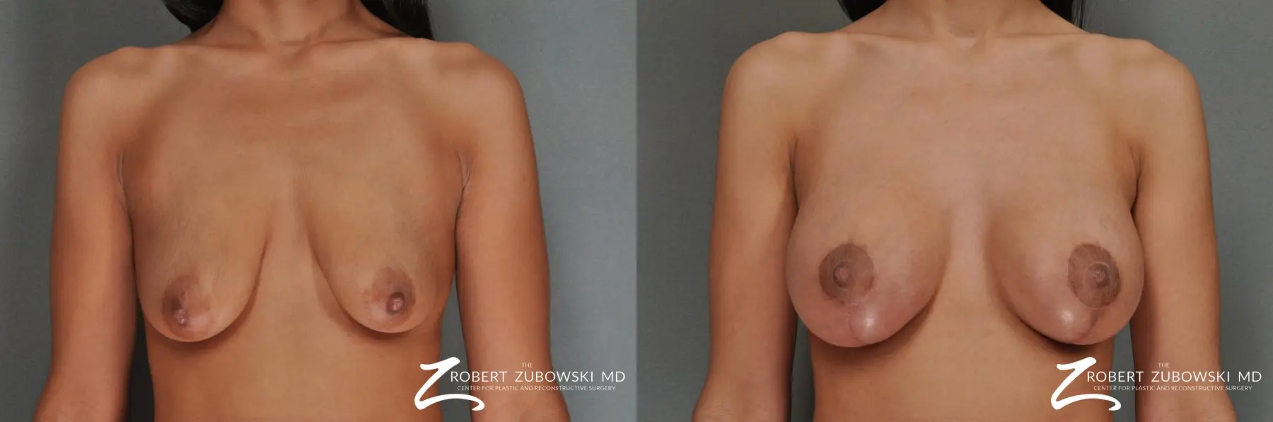 Breast Lift And Augmentation: Patient 7 - Before and After  