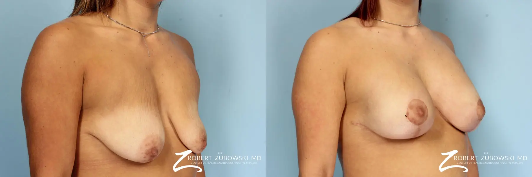 Breast Lift And Augmentation: Patient 9 - Before and After 2