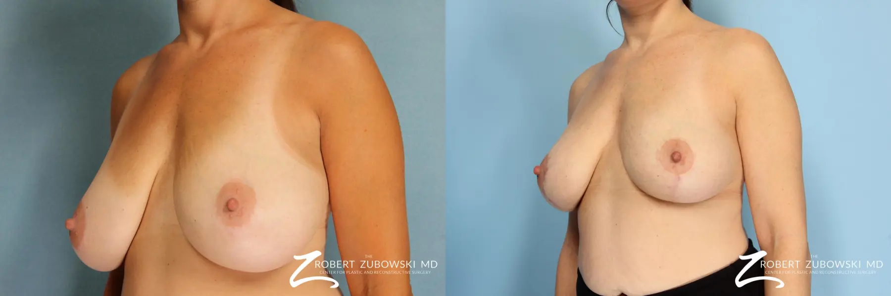 Breast Lift And Augmentation: Patient 8 - Before and After 2