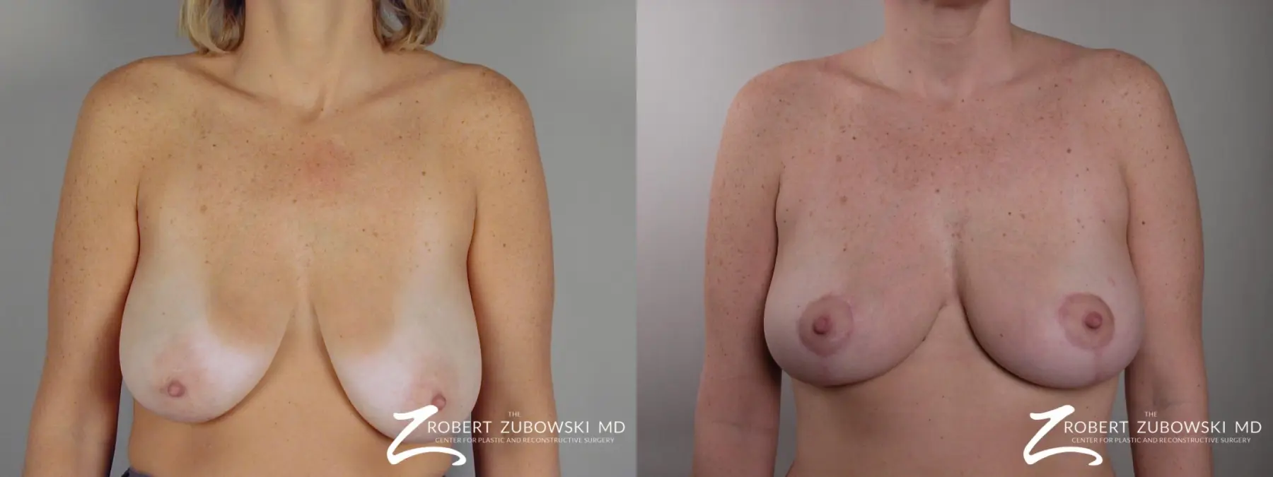 Breast Lift: Patient 13 - Before and After  