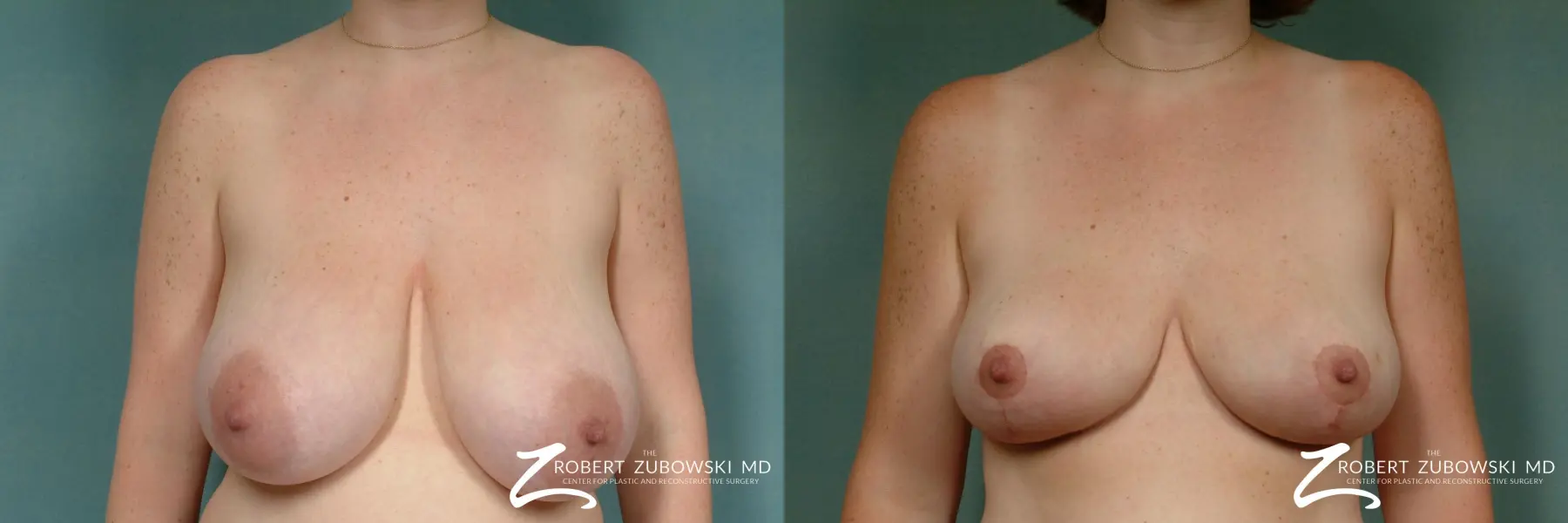 Breast Lift: Patient 1 - Before and After  