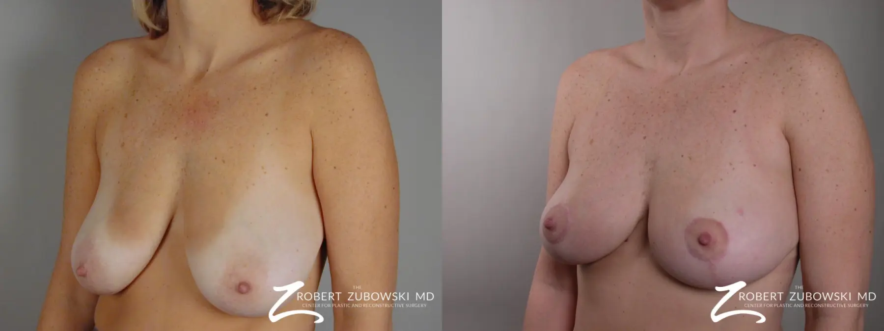 Breast Lift: Patient 13 - Before and After 2