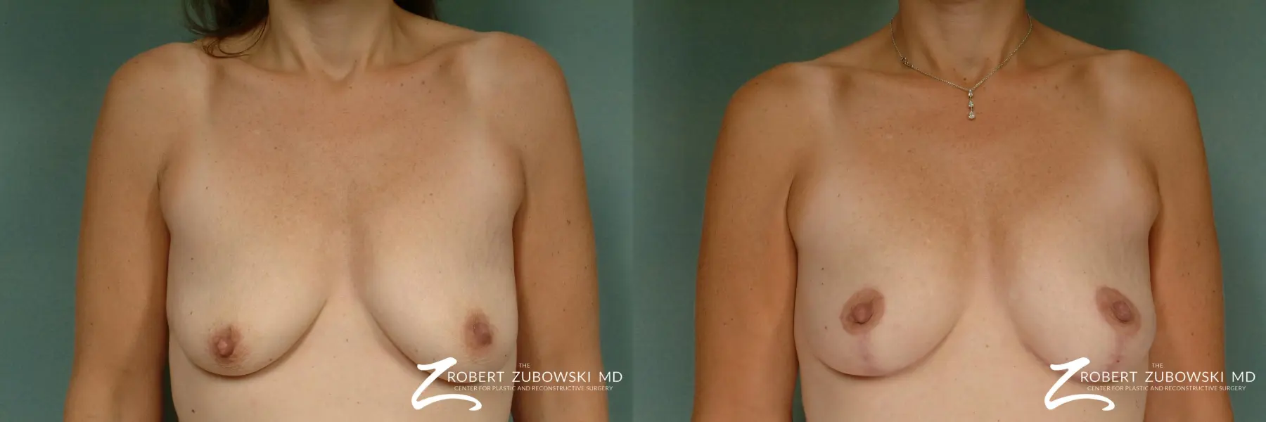 Breast Lift: Patient 11 - Before and After  