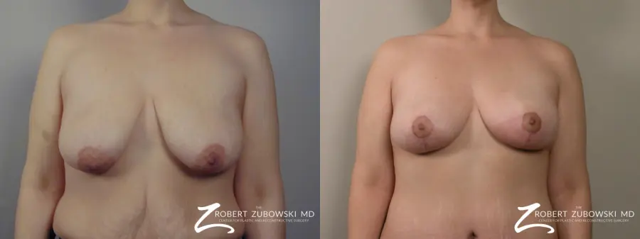Breast Lift: Patient 14 - Before and After  