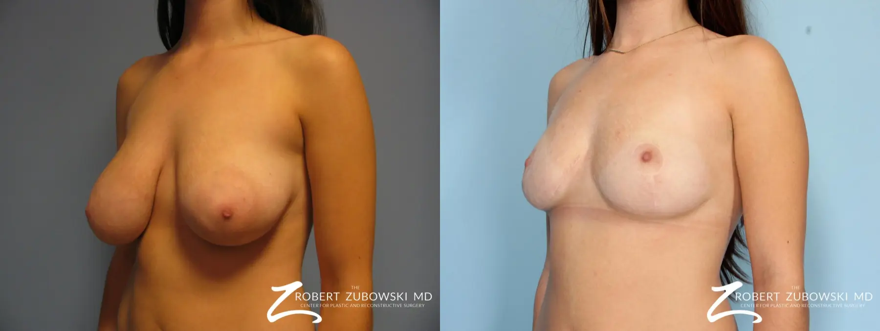 Breast Lift: Patient 12 - Before and After 2