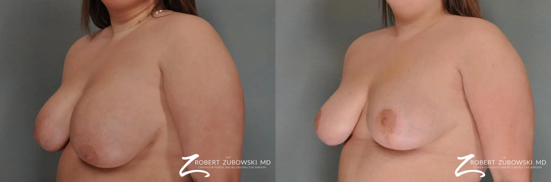 Breast Lift: Patient 10 - Before and After 2