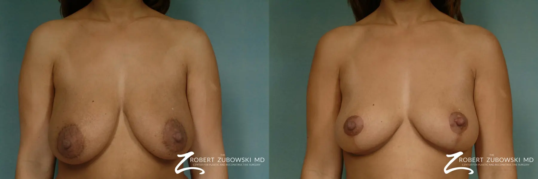 Breast Lift: Patient 4 - Before and After 1