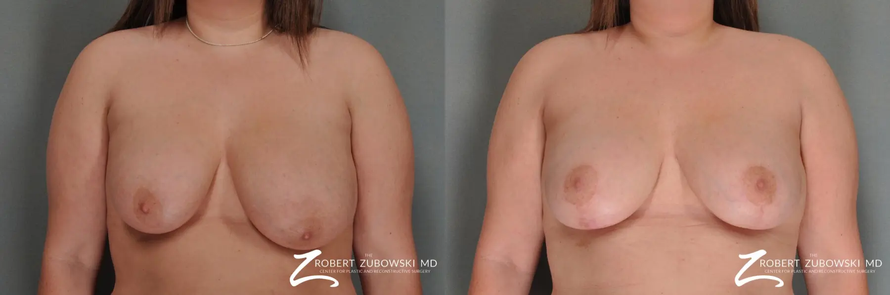 Breast Lift: Patient 10 - Before and After  