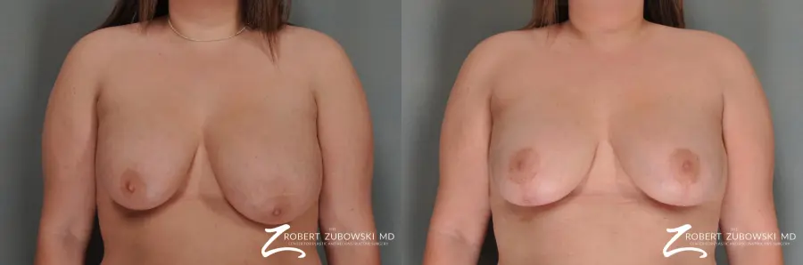 Breast Lift: Patient 13 - Before and After  