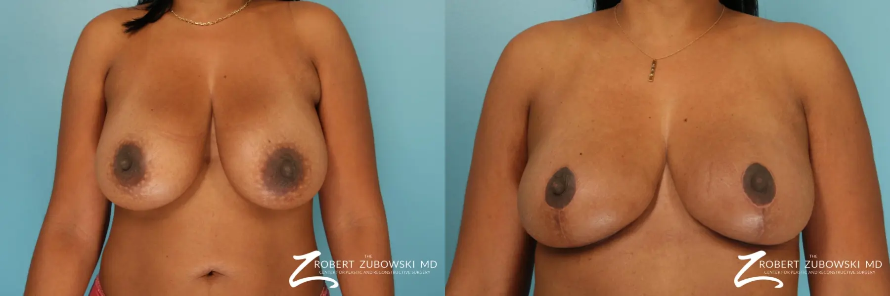 Breast Reduction: Patient 29 - Before and After 1