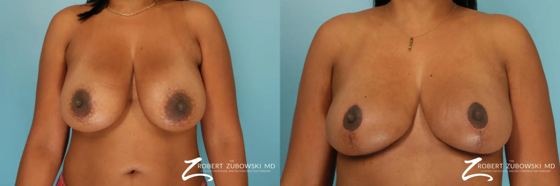 Breast Reduction: Patient 30 - Before and After  