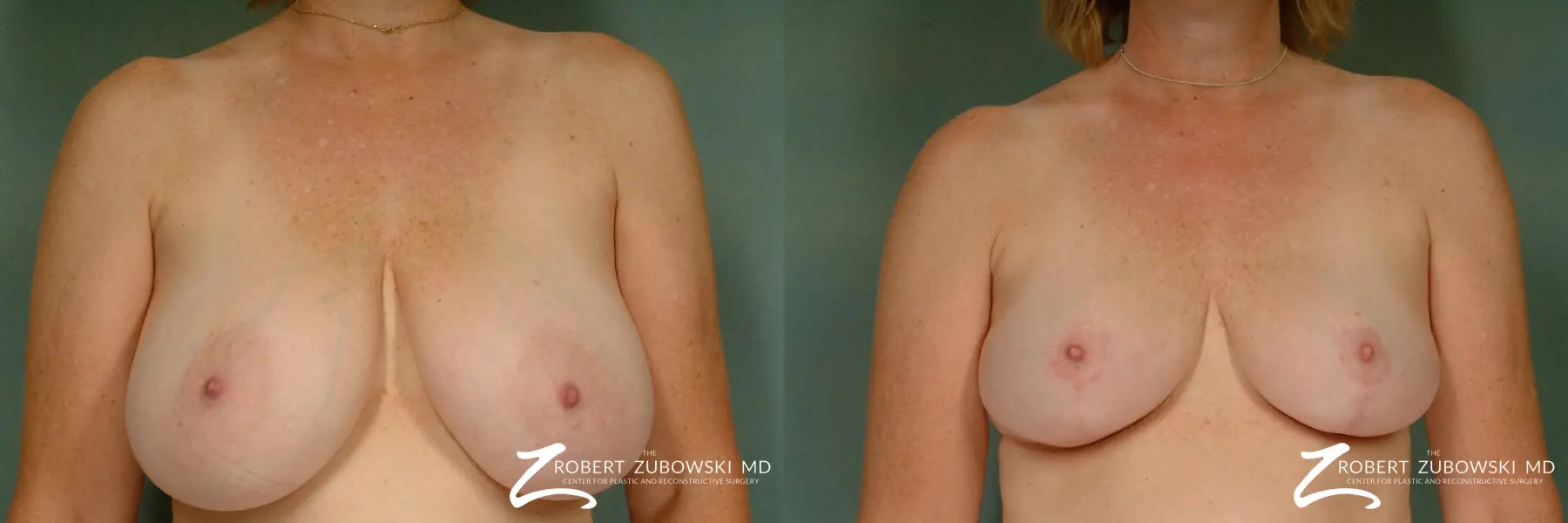 Breast Reduction: Patient 19 - Before and After  