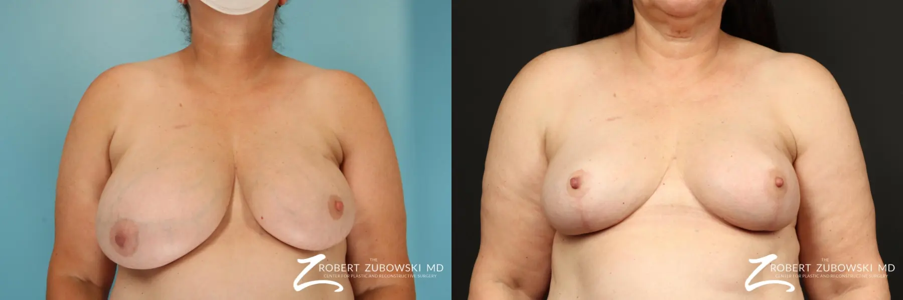 Breast Reduction: Patient 31 - Before and After  