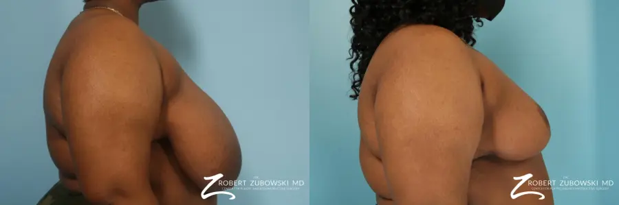 Breast Reduction: Patient 28 - Before and After 2