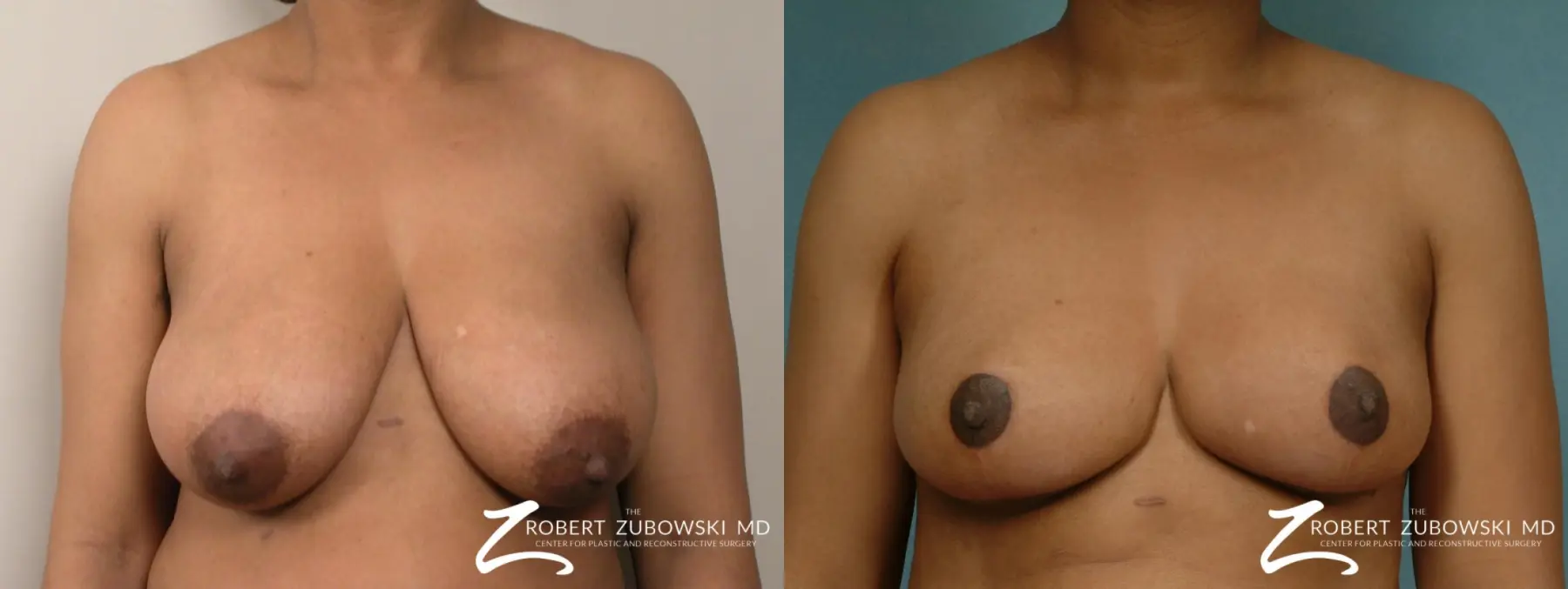 Breast Reduction: Patient 22 - Before and After 1