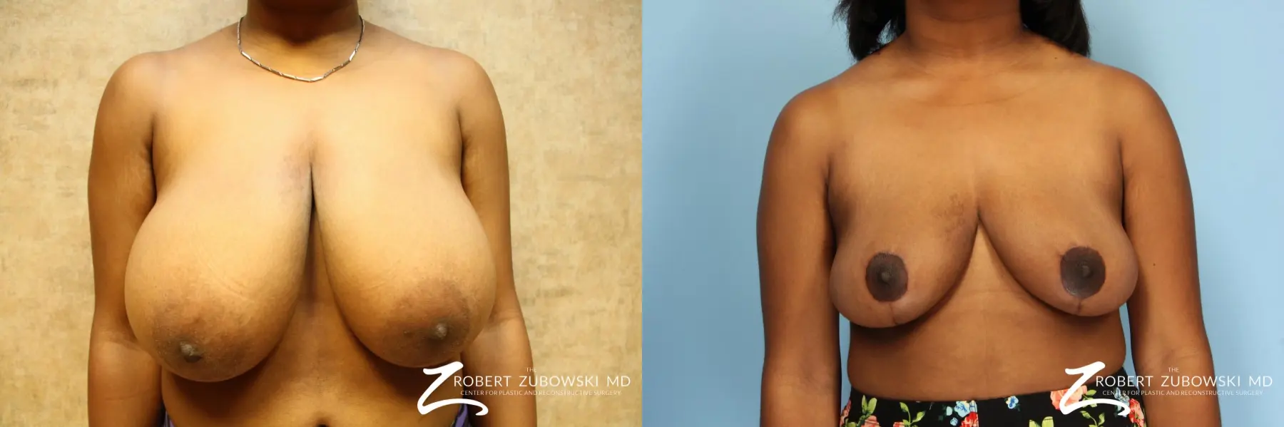 Breast Reduction: Patient 8 - Before and After  