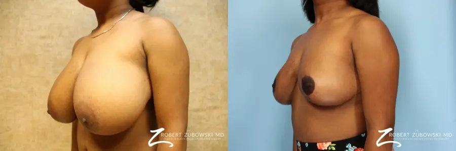 Breast Reduction: Patient 8 - Before and After 2
