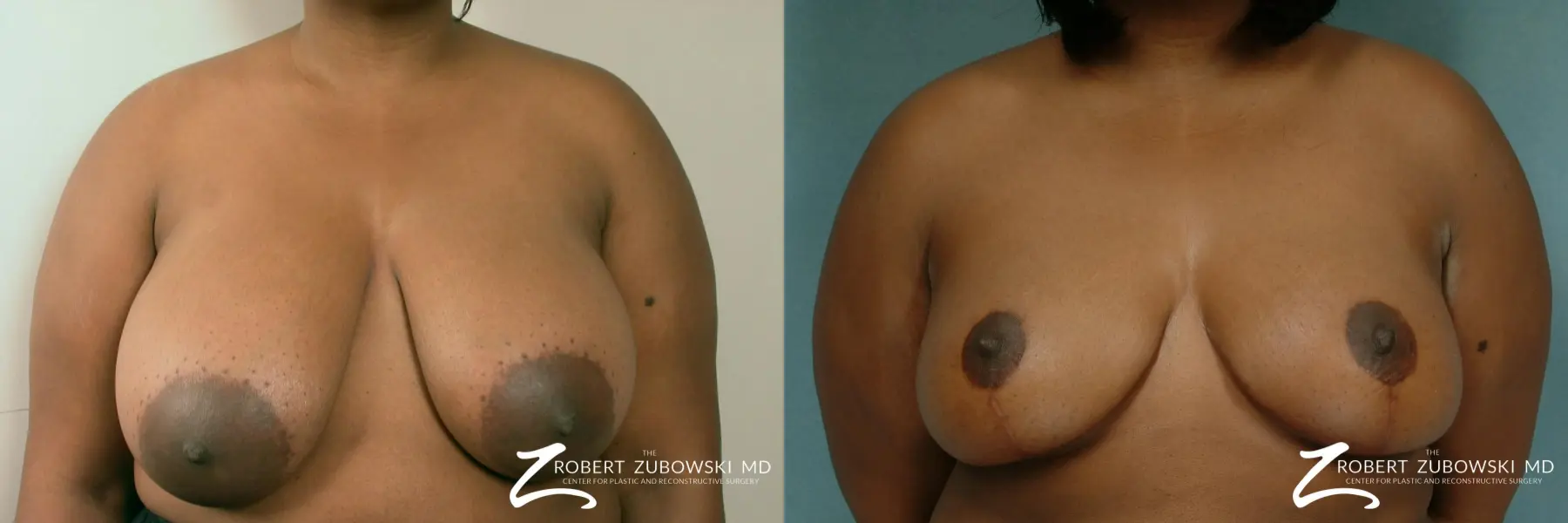 Breast Reduction: Patient 3 - Before and After  