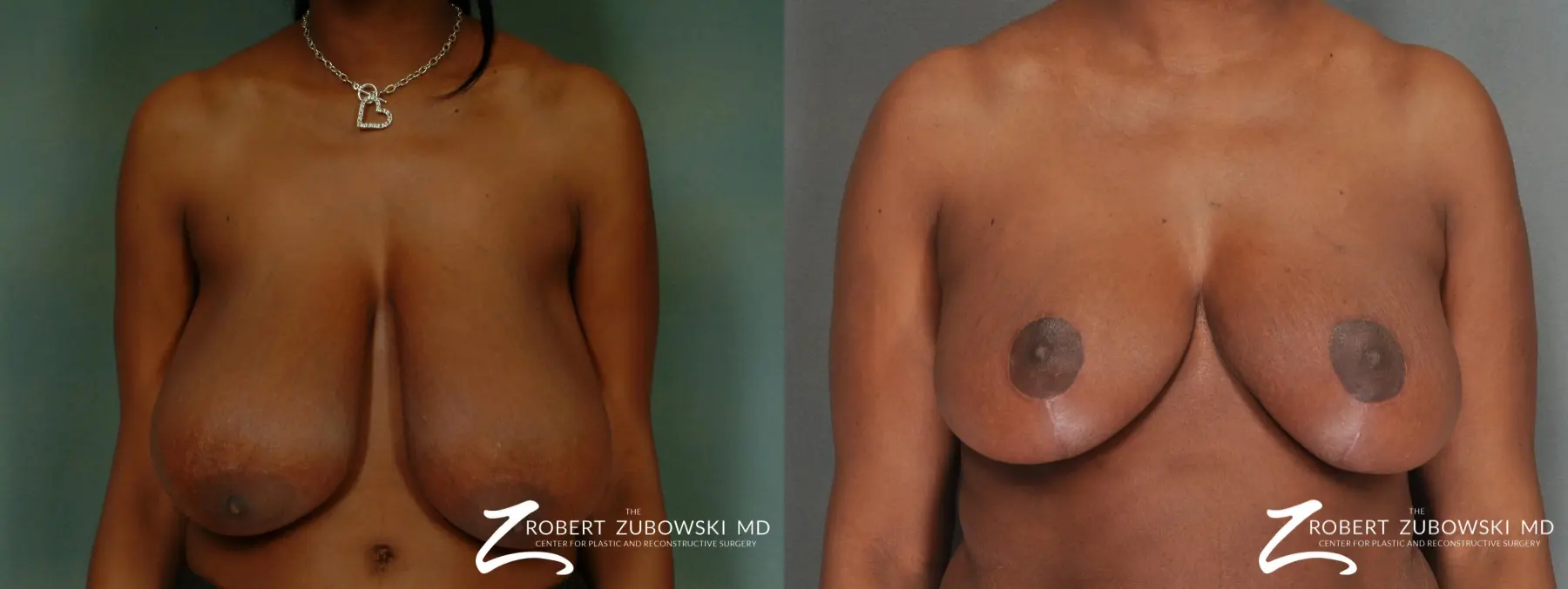 Breast Reduction: Patient 21 - Before and After 1