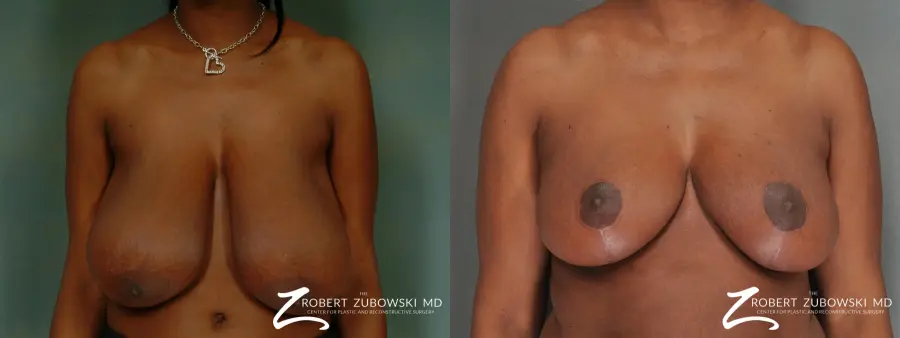 Breast Reduction: Patient 17 - Before and After  