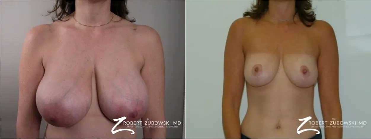 Breast Reduction: Patient 23 - Before and After  