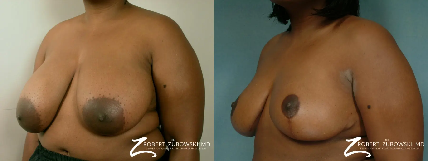 Breast Reduction: Patient 3 - Before and After 2