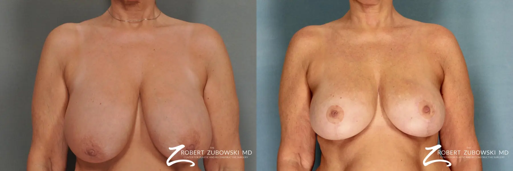 Breast Reduction: Patient 1 - Before and After 1