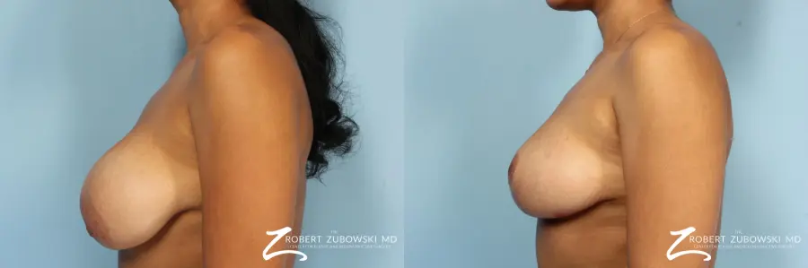 Breast Revision: Patient 1 - Before and After 2