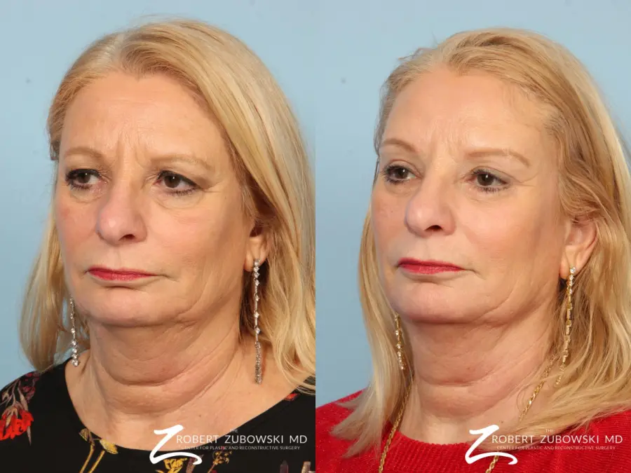Brow Lift: Patient 2 - Before and After 2