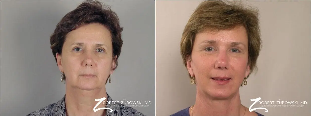Brow Lift: Patient 10 - Before and After  