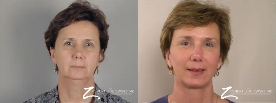 Brow Lift: Patient 1 - Before and After 1
