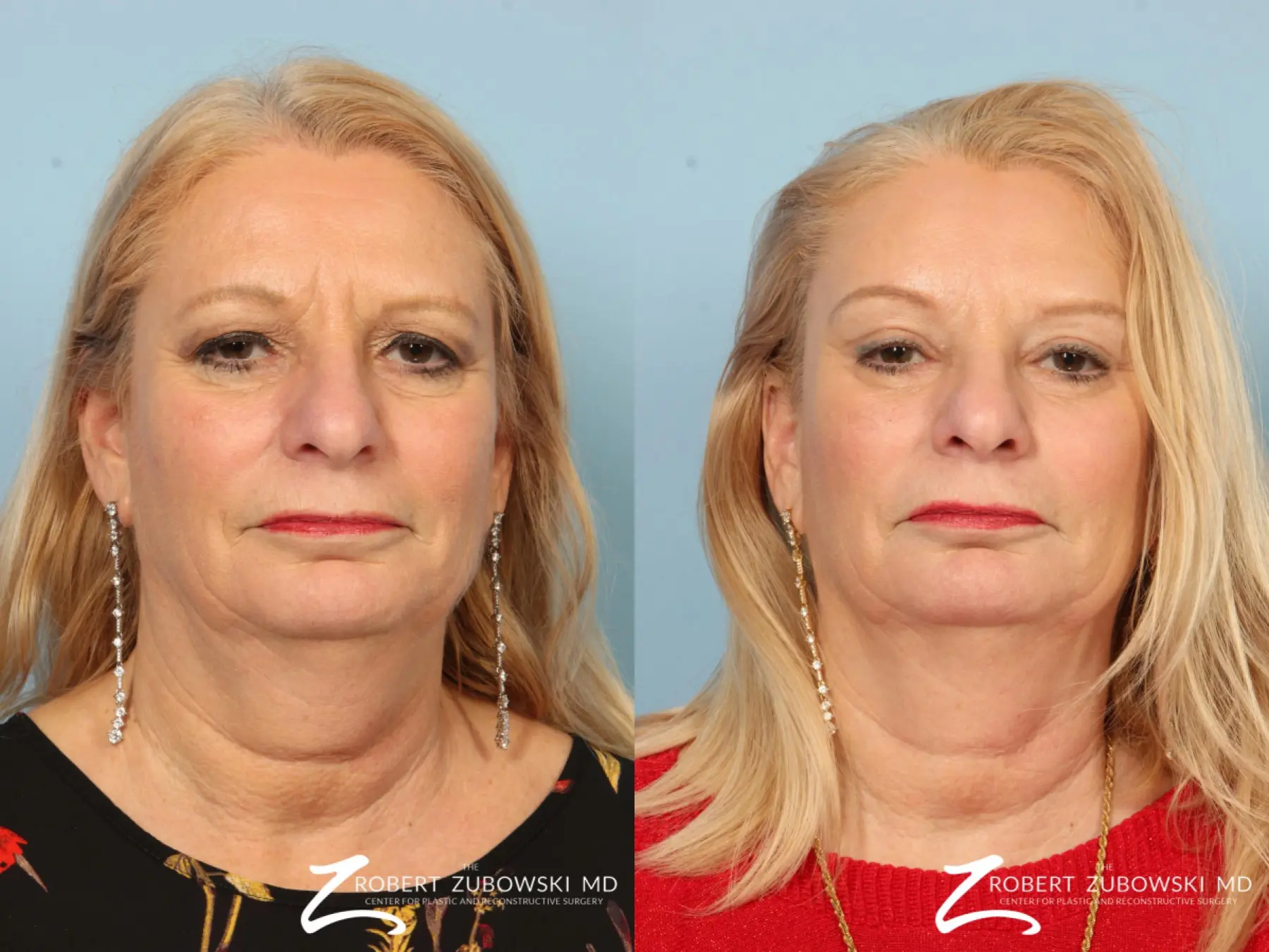 Brow Lift: Patient 2 - Before and After  