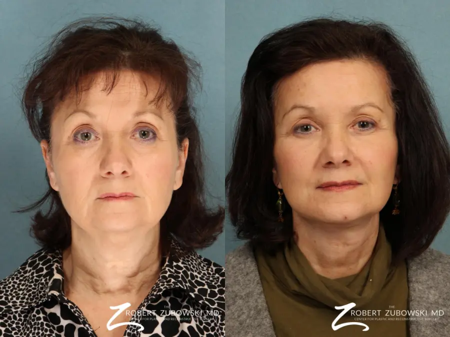 Brow Lift: Patient 6 - Before and After 1