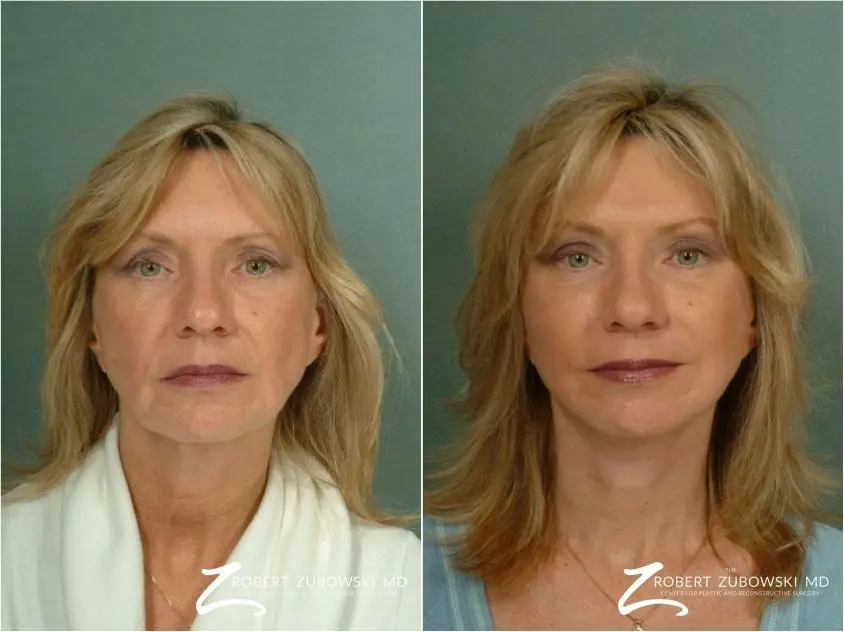 Brow Lift: Patient 4 - Before and After 1