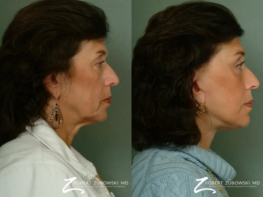 Brow Lift: Patient 5 - Before and After 2